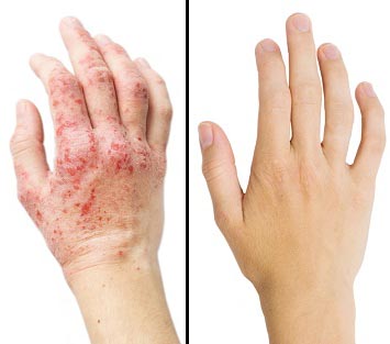 Hands difference with Psorclear